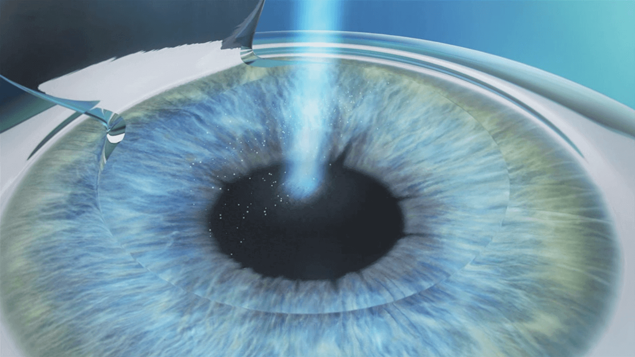 All Laser LASIK · Laser Eye Institute
