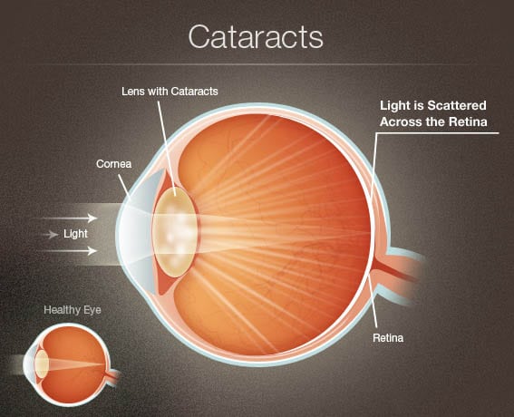 How a cataract impacts vision