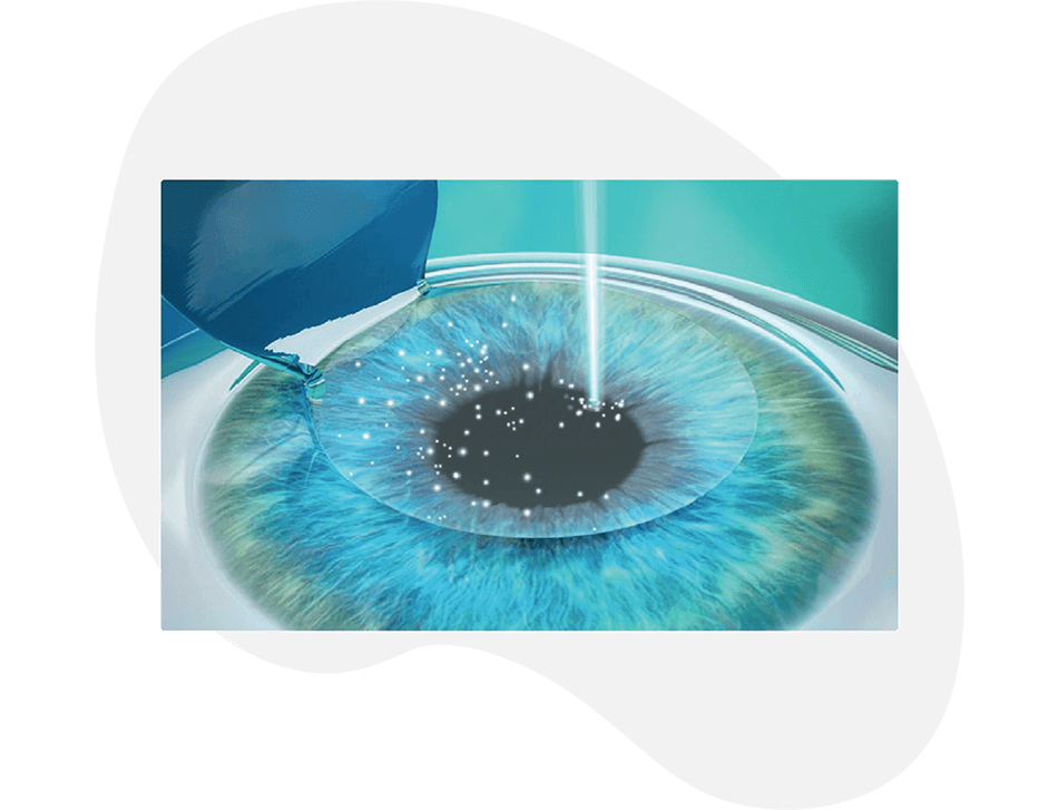 LASIK treatment with excimer laser