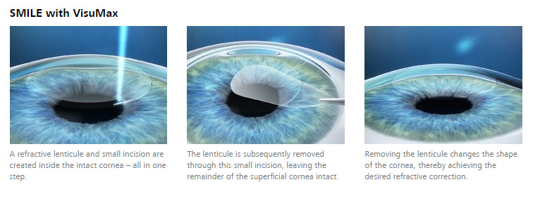 smile lasik steps